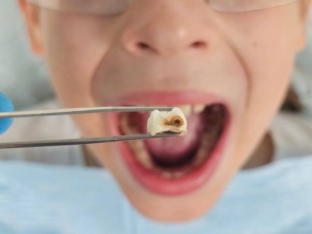 Best Emergency Root Canal Treatment in Ellsworth, WI